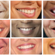 Image for article titled Girls Are More Likely Than Boys to Hate Their Teeth and Want Braces